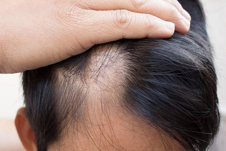 El problema de la alopecia en los niños es más habitual de lo que la gente pueda pensar