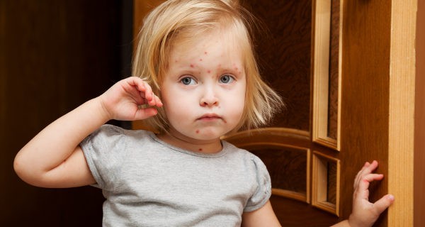 No debemos considerar la varicela como una enfermedad sin importancia