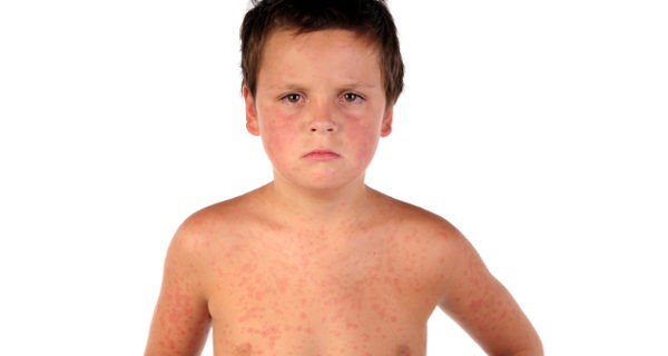 Niño con sarampión