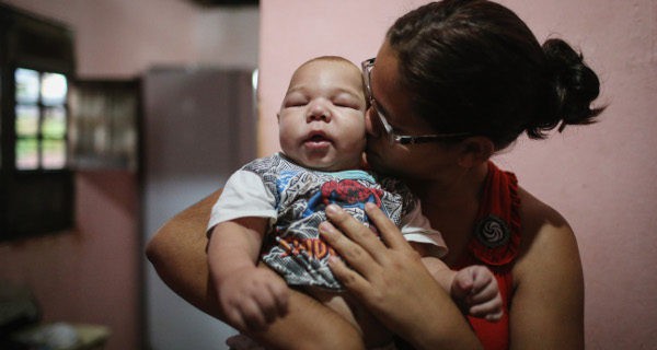 bebé con microcefalia