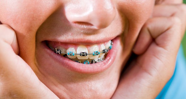 dientes con ortodoncia