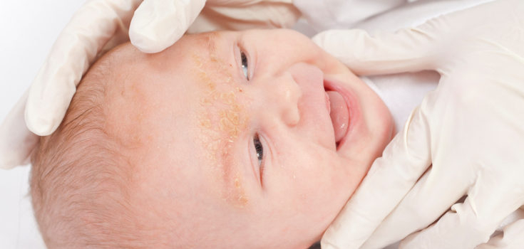 La dermatitis atópica se caracteriza por manchar rojas en la piel y ver al niño inquieto por el picor