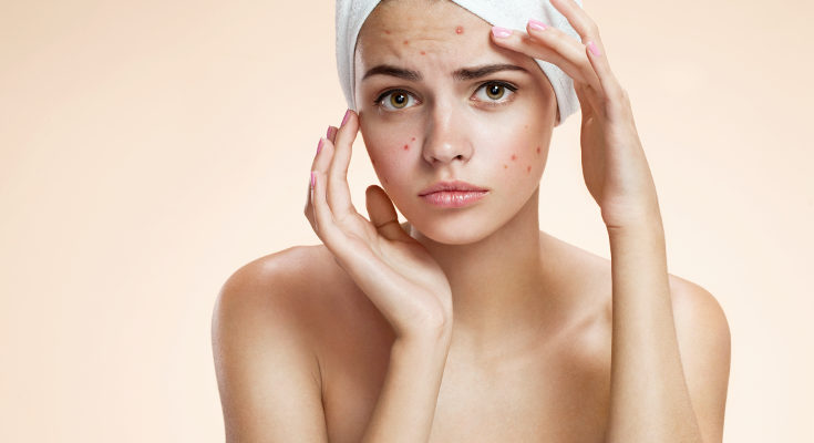 El acné en la adolescencia tiene un origen hormonal