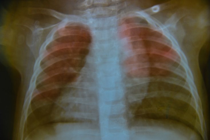 Durante los primeros tres años de la vida de un niño, los pulmones continúan desarrollándose