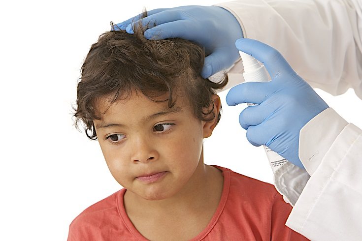 Los piojos afectan en su mayoría a niños y el contagio es de uno a otro 