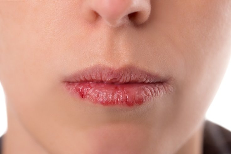 Los labios cortados pueden causar mucho dolor a los hijos