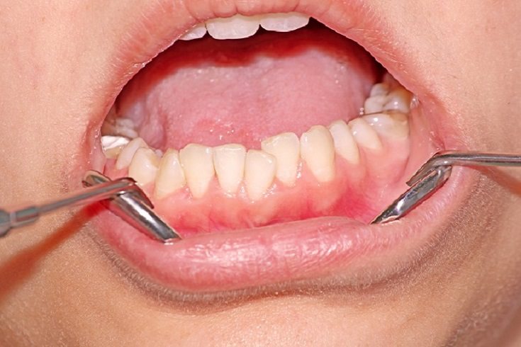 La gingivitis en sus primeras etapas puede tratarse mejorando la higiene oral 