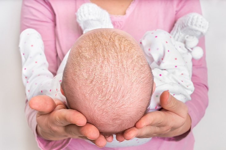 La condición de cuero cabelludo seco generalmente afecta a los bebés en los primeros meses de vida