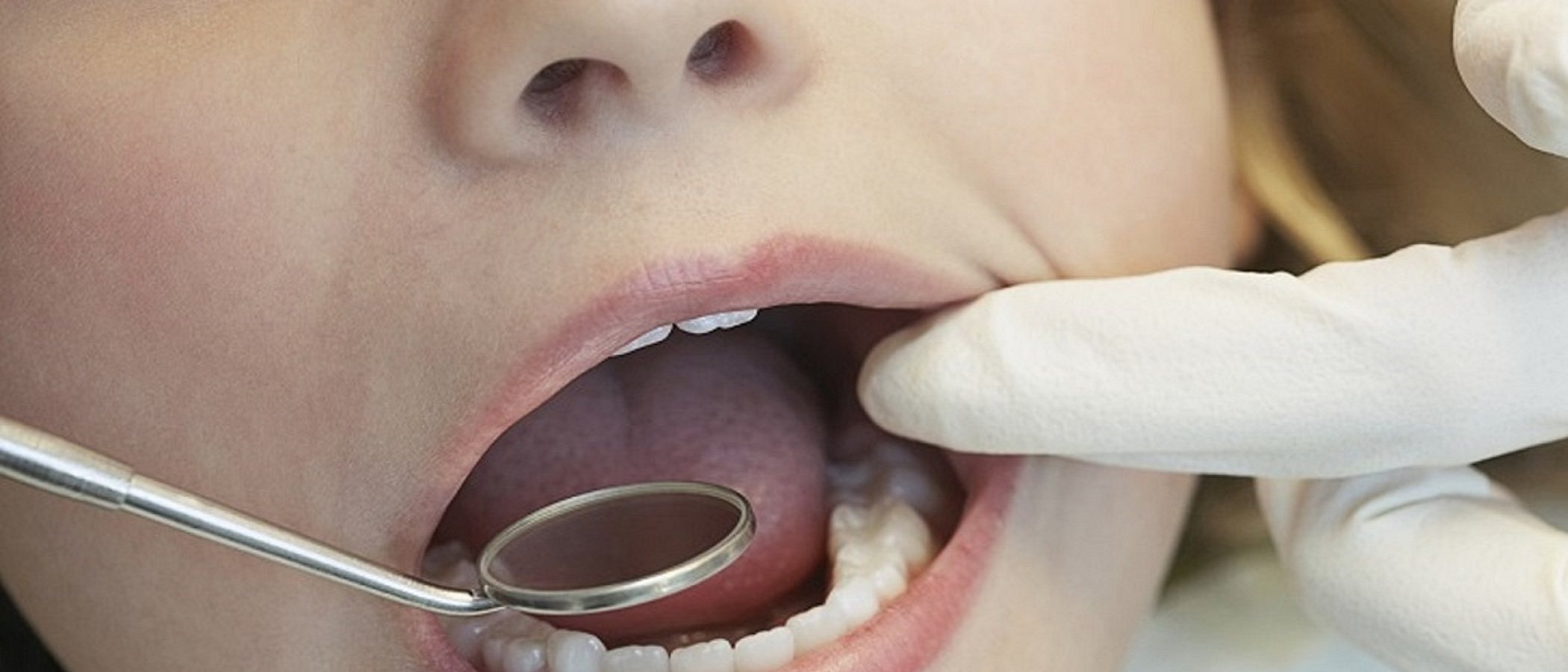 Qué hacer si mi hijo se rompe un diente