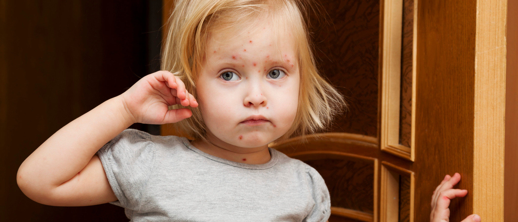 La varicela en niños, la clásica enfermedad infantil