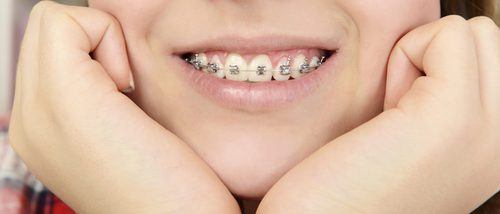 4 signos de que tu hijo o hija necesita ortodoncia o brackets