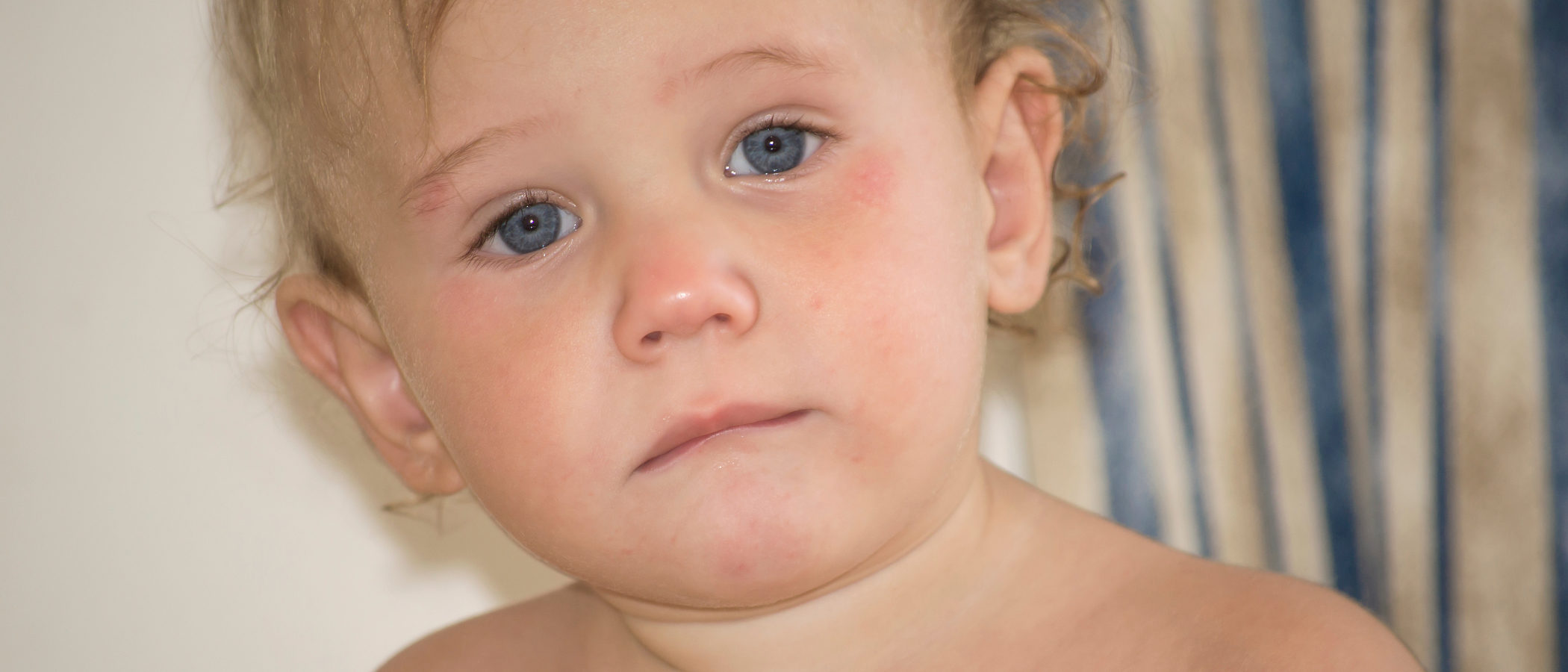 Dermatitis atópica en niños y bebés