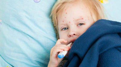 La varicela en niños, la clásica enfermedad infantil