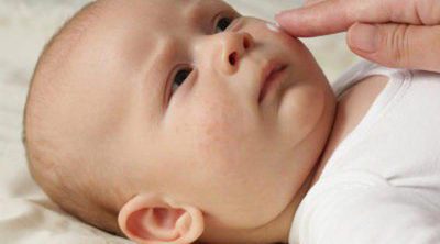 Irritaciones comunes en la piel del bebé