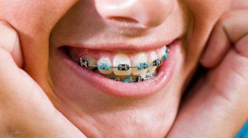 Qué tipos de ortodoncia existen para niños