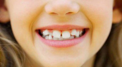 4 signos de que tu hijo o hija necesita ortodoncia o brackets