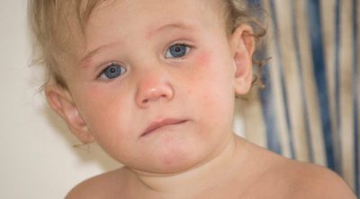 Dermatitis atópica en niños y bebés