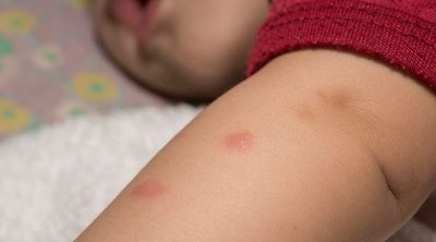 Picaduras de mosquitos en niños, ¿cómo aliviarlas?