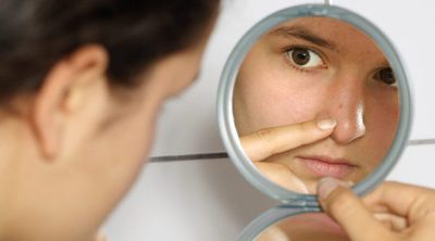 ¿Por qué aparece el acné en la adolescencia?