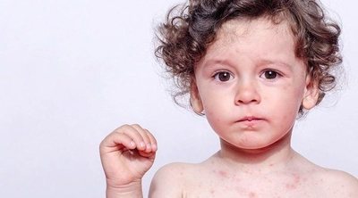 Qué hacer si tus hijos tienen varicela