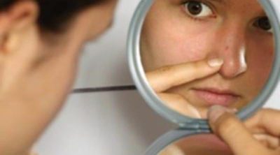 Remedios caseros para prevenir el acné en la adolescencia