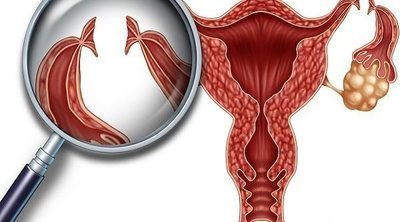 ¿Es posible quedarte embarazada si tienes una ligadura de trompas?
